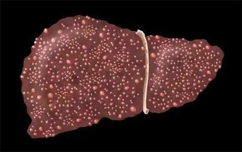 Three steps to stay away from liver cancer defense