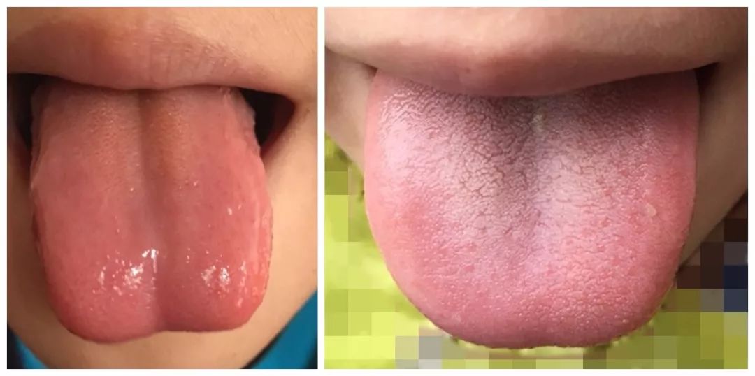 Learn tongue diagnosis and regulate your child’s body