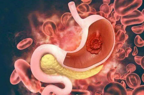 What are the symptoms of stomach cancer