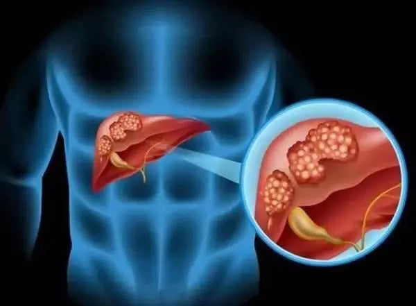 Ninety percent of acute hepatitis drug-induced
