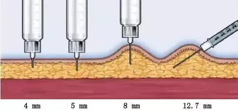 Note: 5 aspects to understand insulin injection